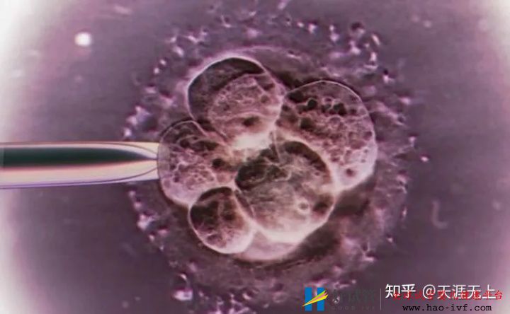 30岁产妇做试管婴儿全过程,看完心疼女人一万遍!(图5) 30岁产妇做试管婴儿全过程,看完心疼女人一万遍!(图5)