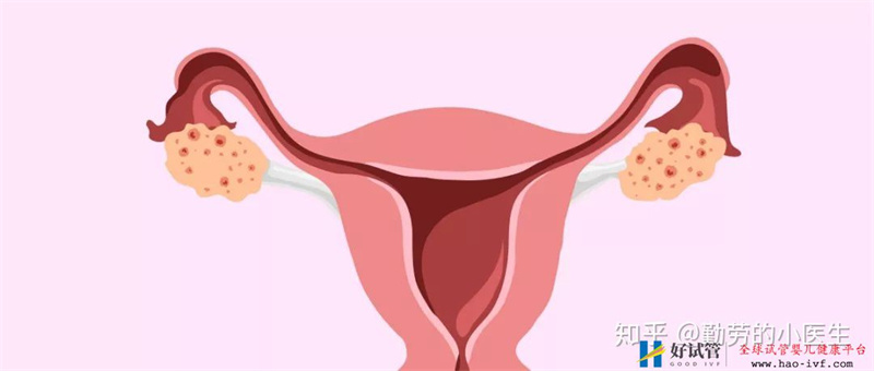 ≥35岁高龄女性的试管婴儿(图1) ≥35岁高龄女性的试管婴儿(图1)