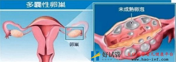 多囊卵巢综合征对试管婴儿成功率有哪些影响如何及时调理(图1) 多囊卵巢综合征对试管婴儿成功率有哪些影响如何及时调理(图1)