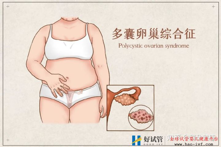 多囊想做试管这几个问题看完心里有谱了!(图2) 多囊想做试管这几个问题看完心里有谱了!(图2)