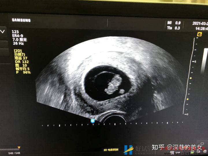 多囊卵巢的促排经历(已怀孕)(图4) 多囊卵巢的促排经历(已怀孕)(图4)