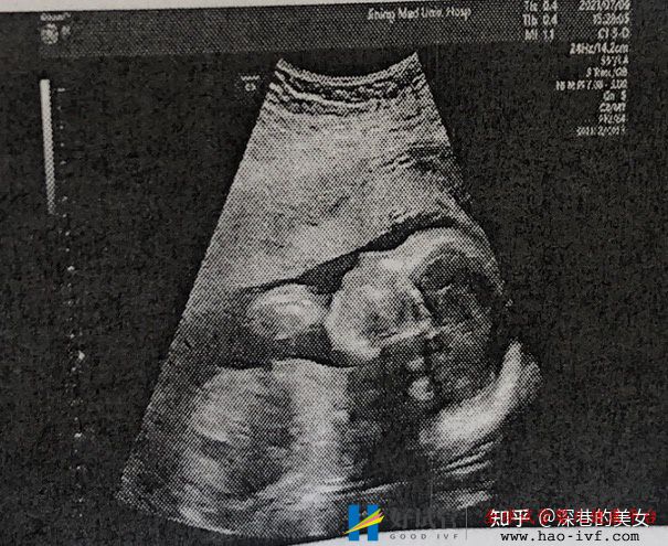 多囊卵巢的促排经历(已怀孕)(图5) 多囊卵巢的促排经历(已怀孕)(图5)