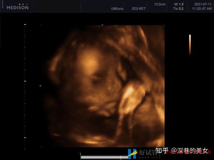 多囊卵巢的促排经历(已怀孕)(图8) 多囊卵巢的促排经历(已怀孕)(图8)