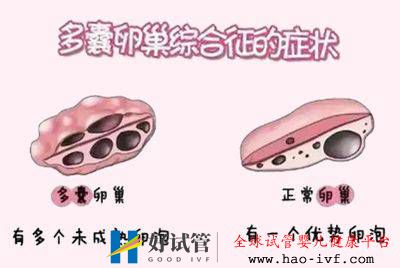 多囊做试管婴儿要注意什么?(图2) 多囊做试管婴儿要注意什么?(图2)