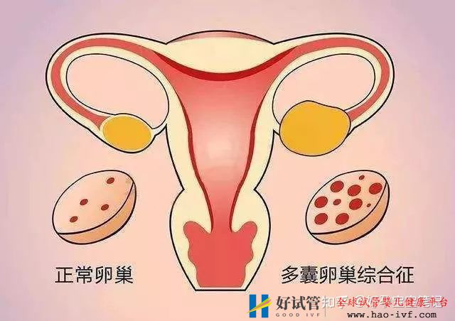 多囊多年至不孕,试管移植二次成功!经验分享!(图2) 多囊多年至不孕,试管移植二次成功!经验分享!(图2)