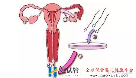 试管婴儿全流程介绍(图7) 试管婴儿全流程介绍(图7)