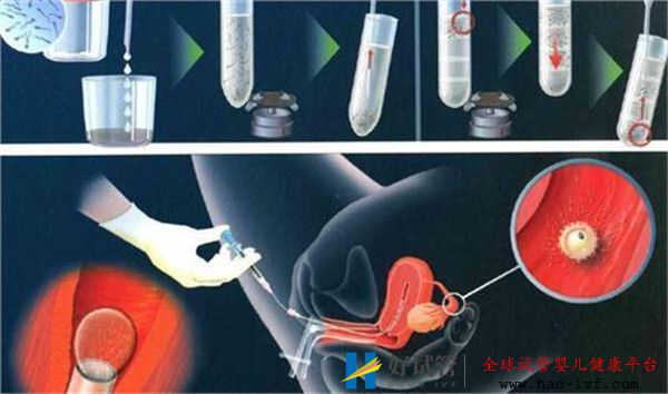 哪几类女性通过试管婴儿移植的成功率高(图1) 哪几类女性通过试管婴儿移植的成功率高(图1)