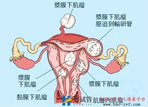 多发性子宫肌瘤可以做试管婴儿吗?你都了解吗(图1) 多发性子宫肌瘤可以做试管婴儿吗?你都了解吗(图1)