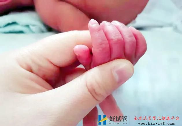 试管婴儿双胞胎龙凤胎的概率(图2) 试管婴儿双胞胎龙凤胎的概率(图2)