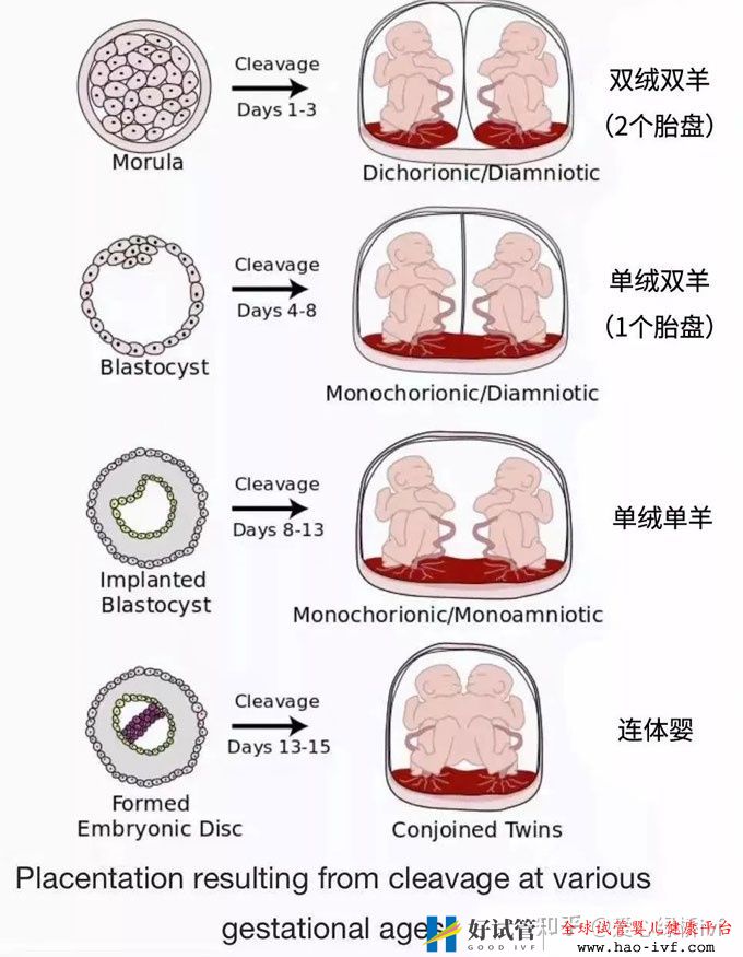 试管双胞胎是单绒还是双绒(图1) 试管双胞胎是单绒还是双绒(图1)