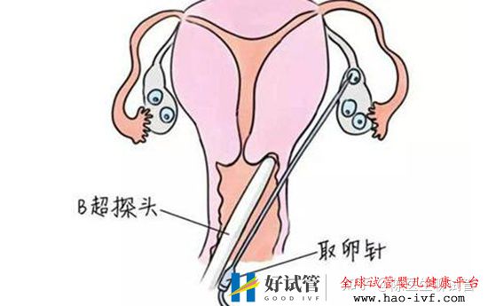 试管婴儿过程痛苦吗一篇来自医生最真实的解读(图2) 试管婴儿过程痛苦吗一篇来自医生最真实的解读(图2)