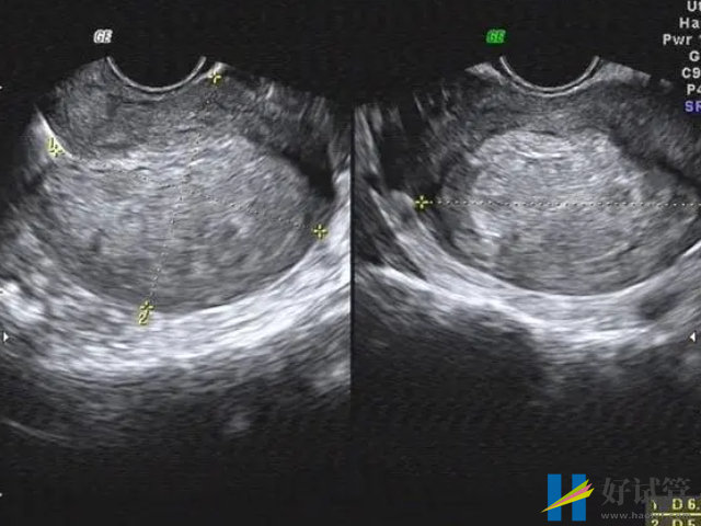 子宫息肉最佳治疗方法有3种,单靠中医调理效果不理想(图2) 病原体感染会导致子宫息肉
