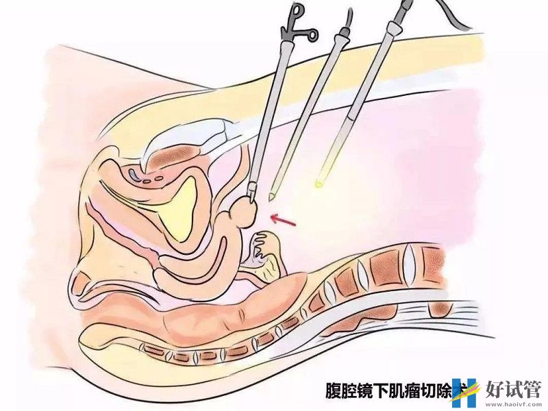 子宫肌瘤降低试管成功率不可信,但后果竟是胎位不正!(图2) 试管前先治疗子宫肌瘤