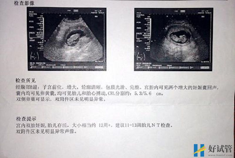 孕妈频频出现胎梦皆为暗示,原来怀双胞胎早有征兆(图3) 怀双胞胎的B超单
