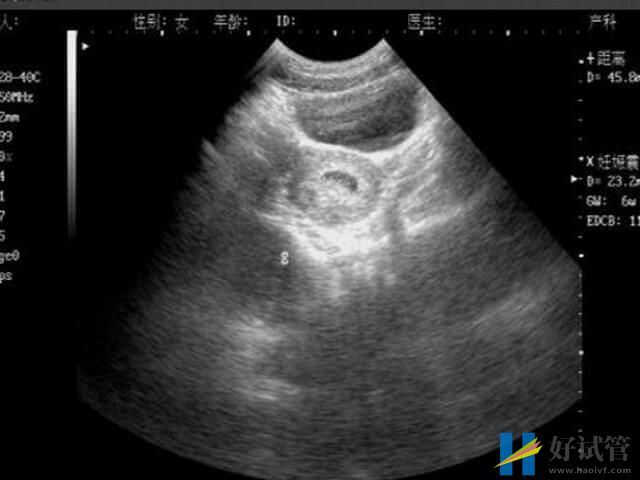 为什么孕9到11周最容易发生胎停?(图1) 孕早期胚胎发育不完善易胎停