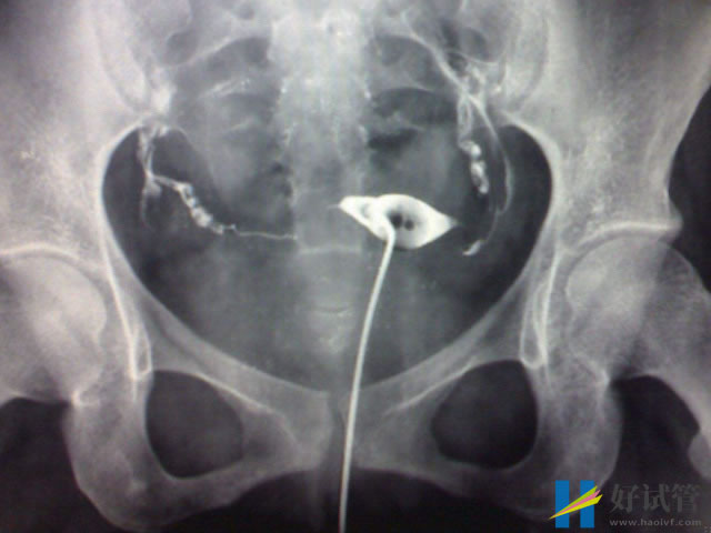 输卵管堵塞三种类型详解,不同程度检查及治疗方法均不同(图3) 输卵管堵塞有三种类型
