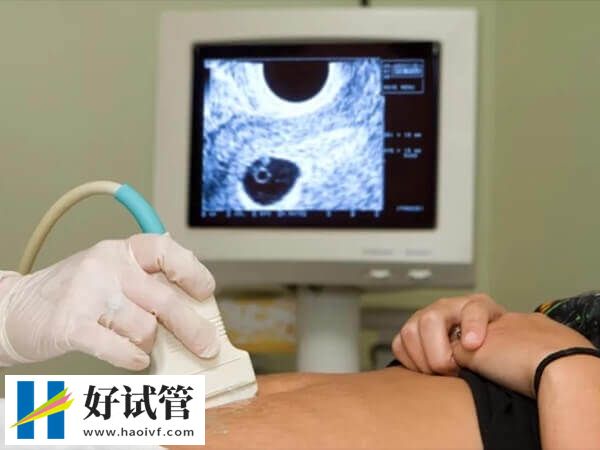 黔东南试管婴儿的专业术语有哪些(图7) 试管婴儿需要做b超进行排卵监测