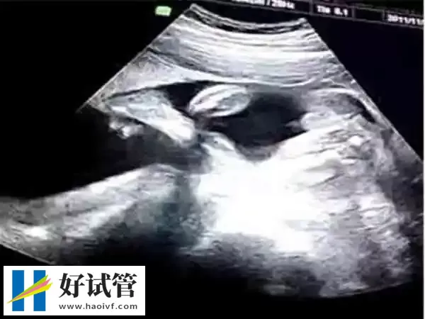 巴中试管婴儿移植35天孕囊偏小怎么办(图1) 孕囊小不一定是胎停育