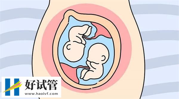 三代试管婴儿生双胞胎的概率(图3) 试管婴儿双胎妊娠注意事项