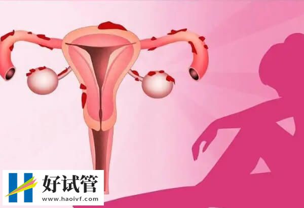 子宫内膜异位症的原因有哪些(图1) 月经逆流是导致子宫内膜异位症的原因