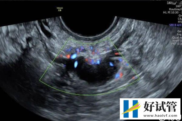 取卵后医生说下个月移植是什么意思,是不是怀孕瞧完清楚(图3) 内膜状态影响妊娠结果