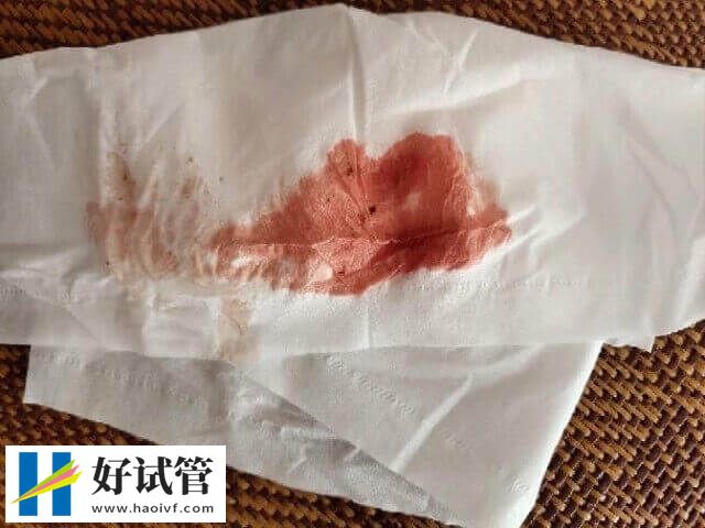 试管移植后不规则出血怎么办么办(图1) 试管移植后阴道出血可能是着床了