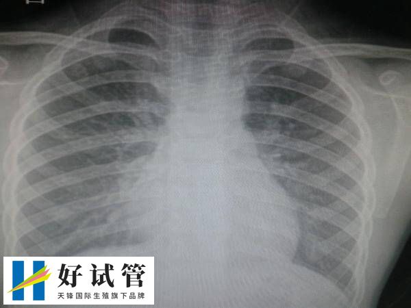 试管前做胸透为了检查什么(图1) 做试管拍胸片是常规体检项目之一