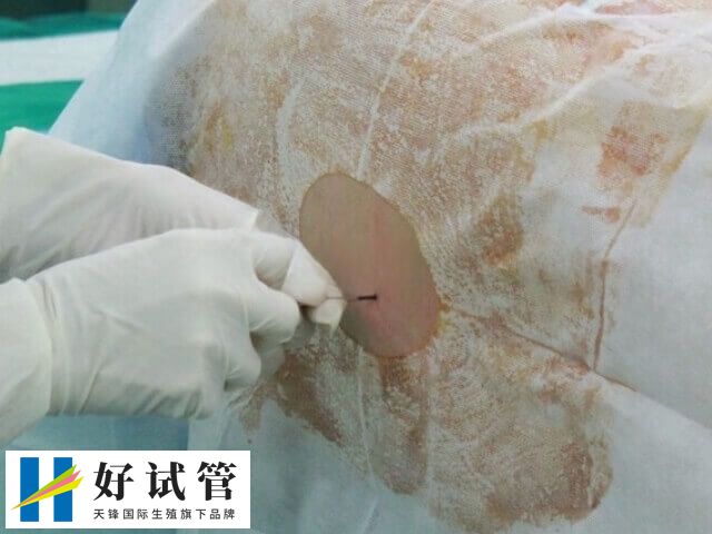 试管婴儿为什么还要做宫腔镜(图1) 宫腔镜是一种微创性妇科诊疗技术