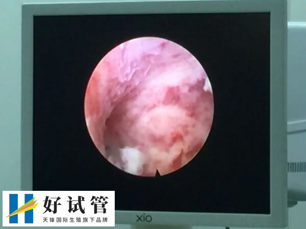 试管婴儿为什么还要做宫腔镜(图2) 宫腔镜可以确诊宫腔疾病