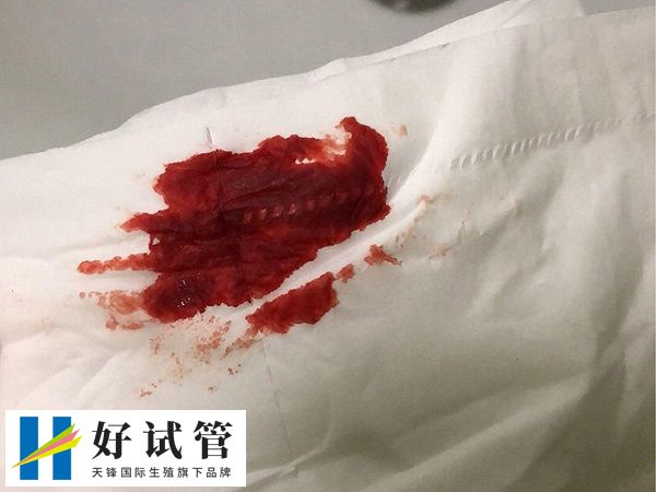 胚胎移植后出血能不能保住胎儿(图2) 胚胎移植后出血可能是着床出血