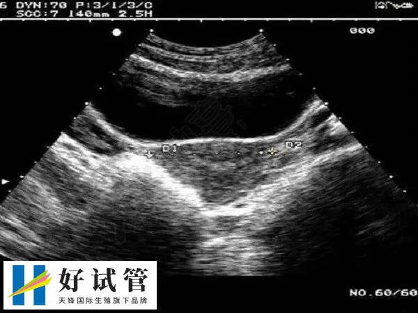 降低试管婴儿妊娠率的疾病有哪些(图2) 子宫内膜异位症可能会影响排卵