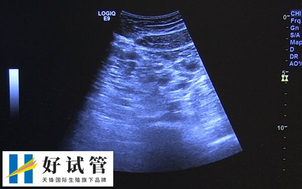 长方案促排卵泡大小不一怎么回事(图2) 卵巢功能减退会影响卵泡发育