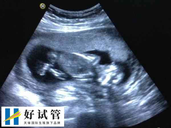 做试管宫腔镜后多久移植最佳(图1) 不做宫腔镜不影响移植