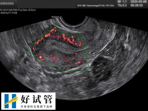 试管二超检查可以推迟多久做(图1) 二超检查通常建议在移植后一个月进行