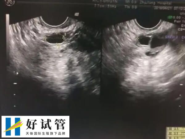 女人有梅毒可不可以做人工授精(图1) 人工授精过程中需严格无菌操作