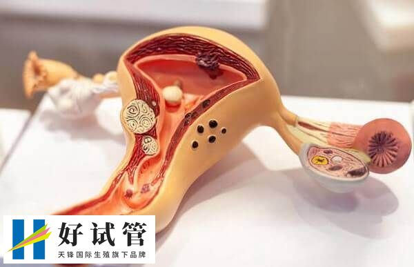 子宫腺肌症打达菲林有没有效果(图1) 达菲林就可治疗子宫腺肌症