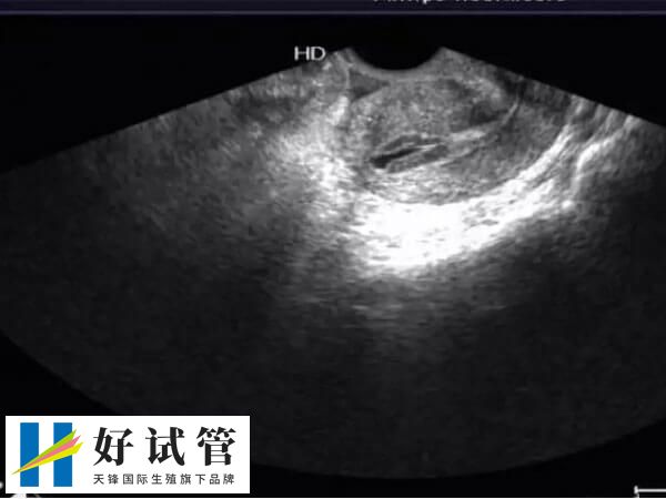 日本试管成功率有多大(图3) 试管前的全面检查有助提高试管成功率