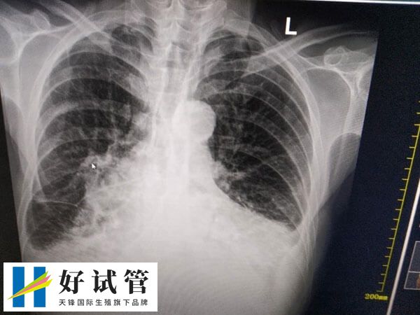 试管移植后肩胛骨疼怎么回事(图1) 试管移植后出现肩胛骨疼痛可能是激素引起