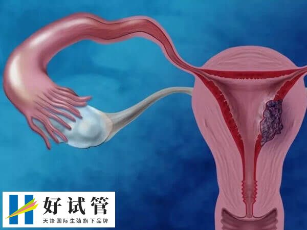 多囊做试管婴儿前怎么调理(图1) 多囊卵巢会引起不孕不育